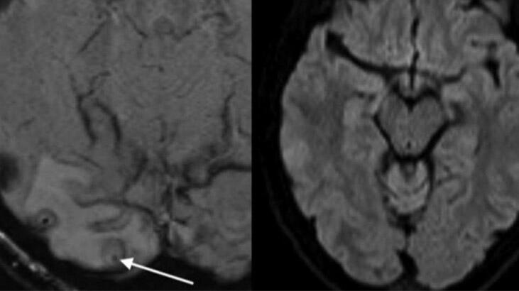 Baş ağrısından şikayet ediyordu... Beyninden tenya çıktı!