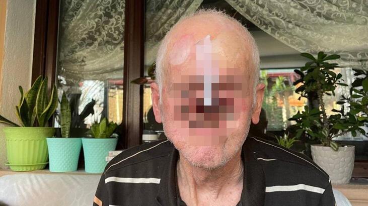 Burnunda çıkan sivilceyle hayatı kabusa döndü! Her gün milim milim eridi